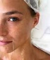 Face Acupuncture Skin Care Trend Botox Alternative