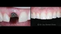 Dental Implants | Dental Implants Clinic Dubai | Affordable & Same ...
