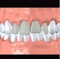 Dental Veneers Lansdale PA