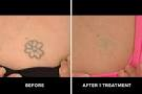 Laser Tattoo Removal Cost Austin TX | Pigment Tattoo