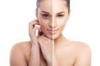 Northern Virginia Skin Care Treatments - Body Laser Center Fairfax ...