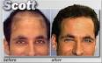 Medical Hair Restoration in Chevy Chase, MD - YellowBot
